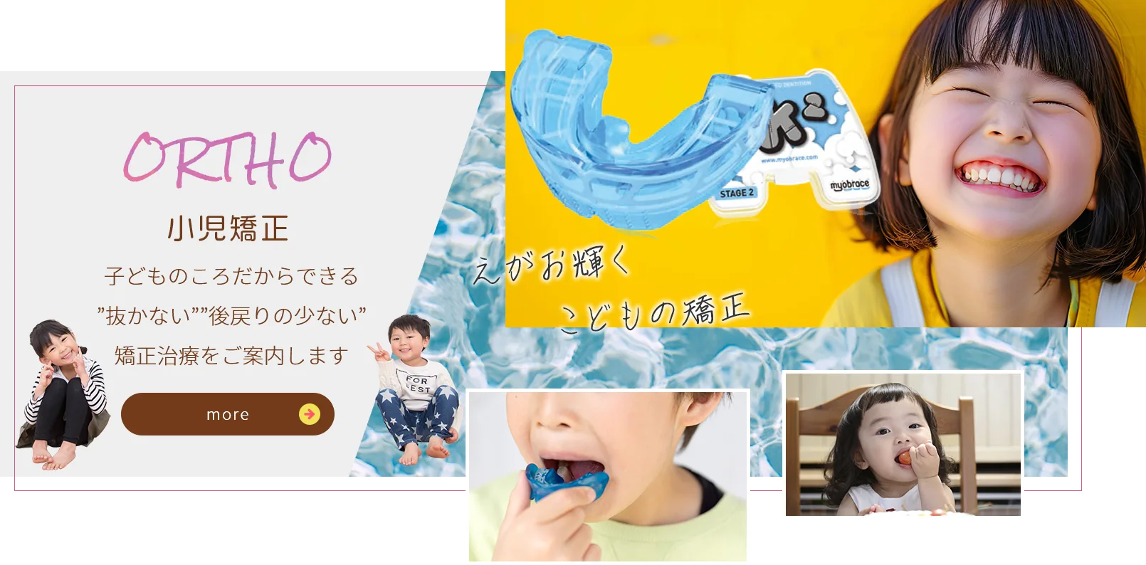 小児矯正｜子どものころだからできる「抜かない」「後戻りの少ない」矯正治療をご案内します